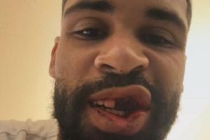 有点惨！奇克社媒报平安，晒自己多颗牙齿脱落照